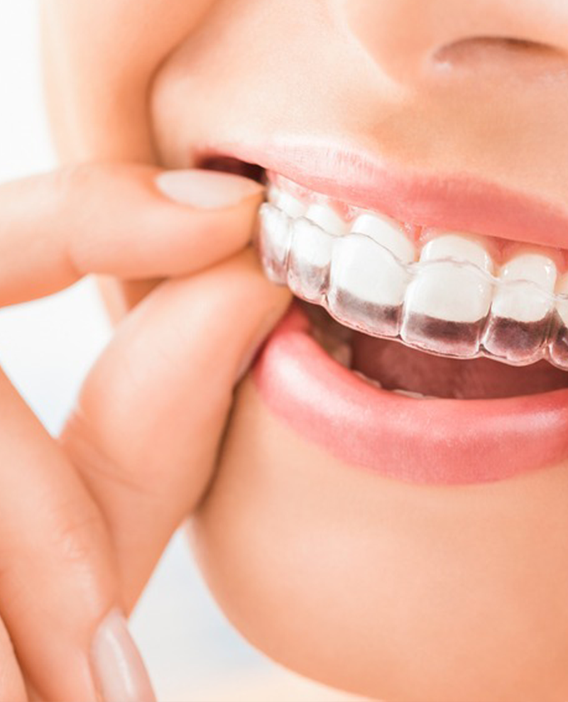 Invisalign NYC | facial aesthetic treatments in nyc