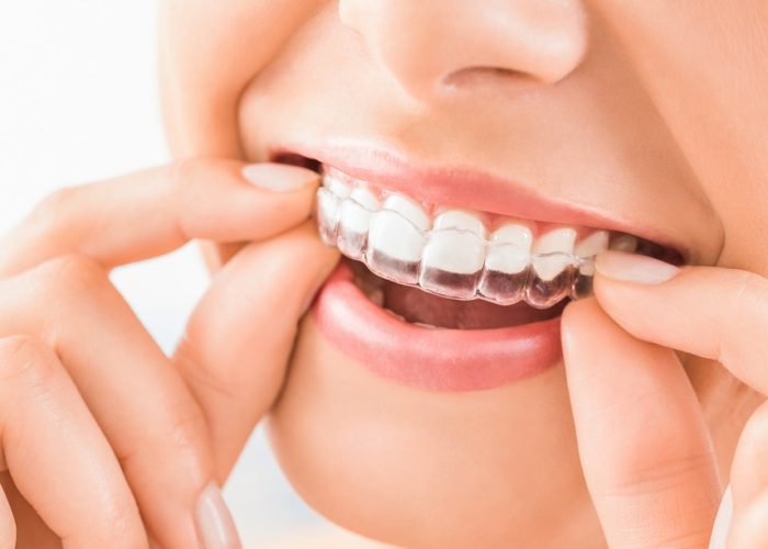 invisible-aligners orthodontist in New York city | Invisalign dentist nyc