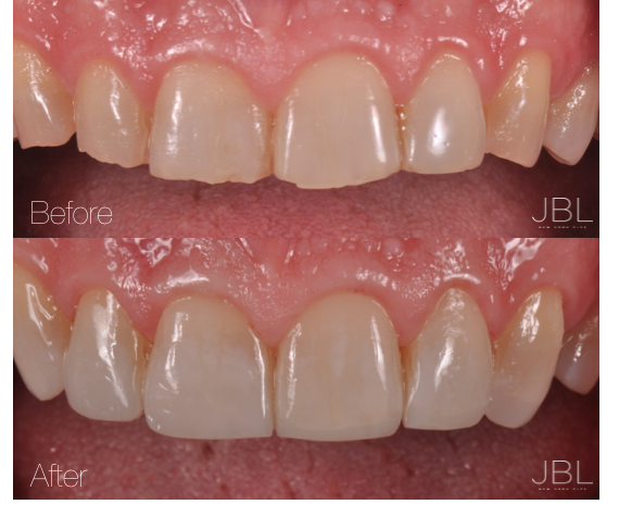 Dental Bondings NYC | JBL New York City Before and After Amile