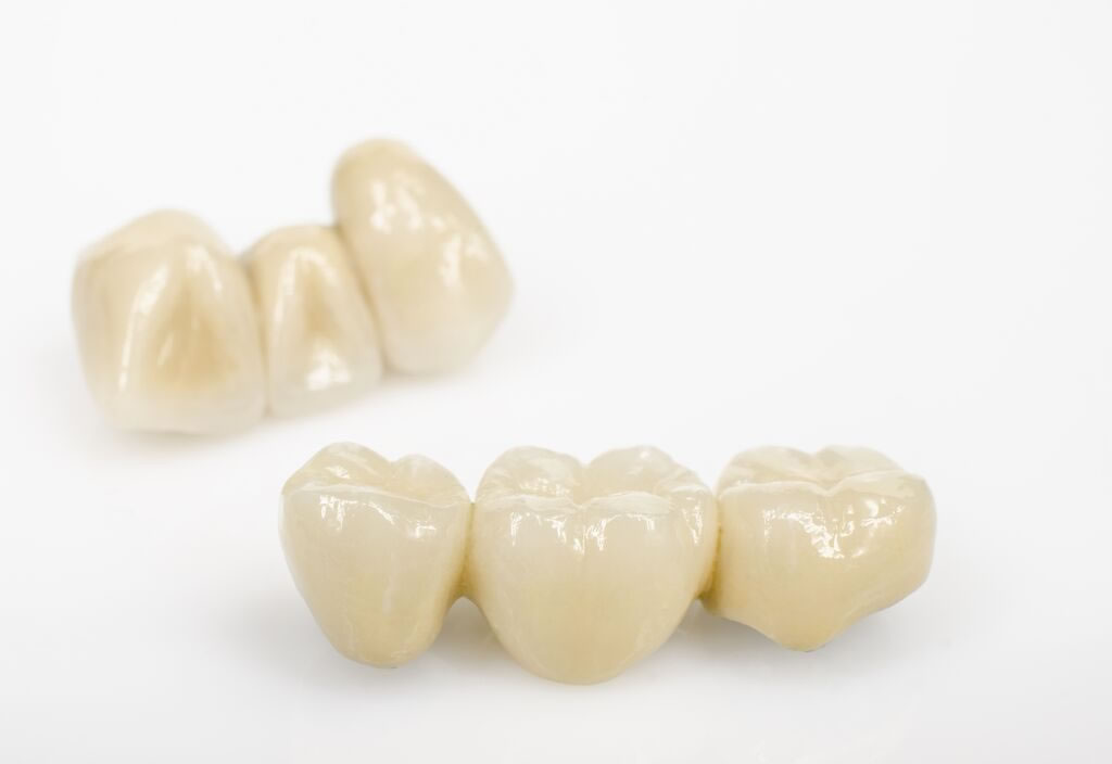 dental bridge in nyc | JBL New York City