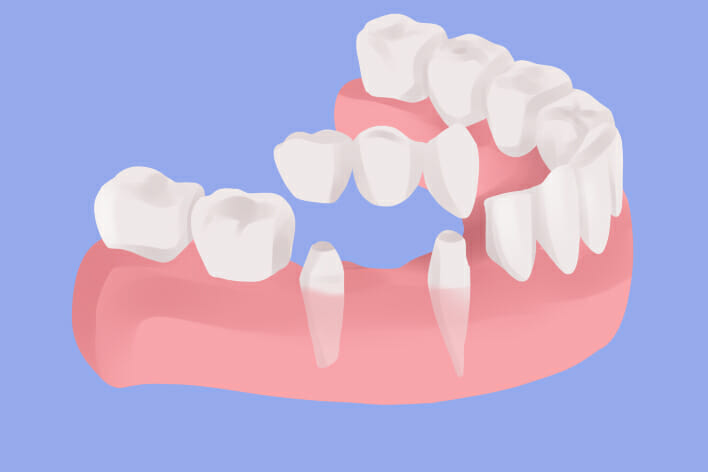teeth replacement in nyc | JBL New York City