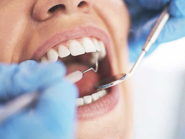 dental filling | JBL New York City Dental Filling