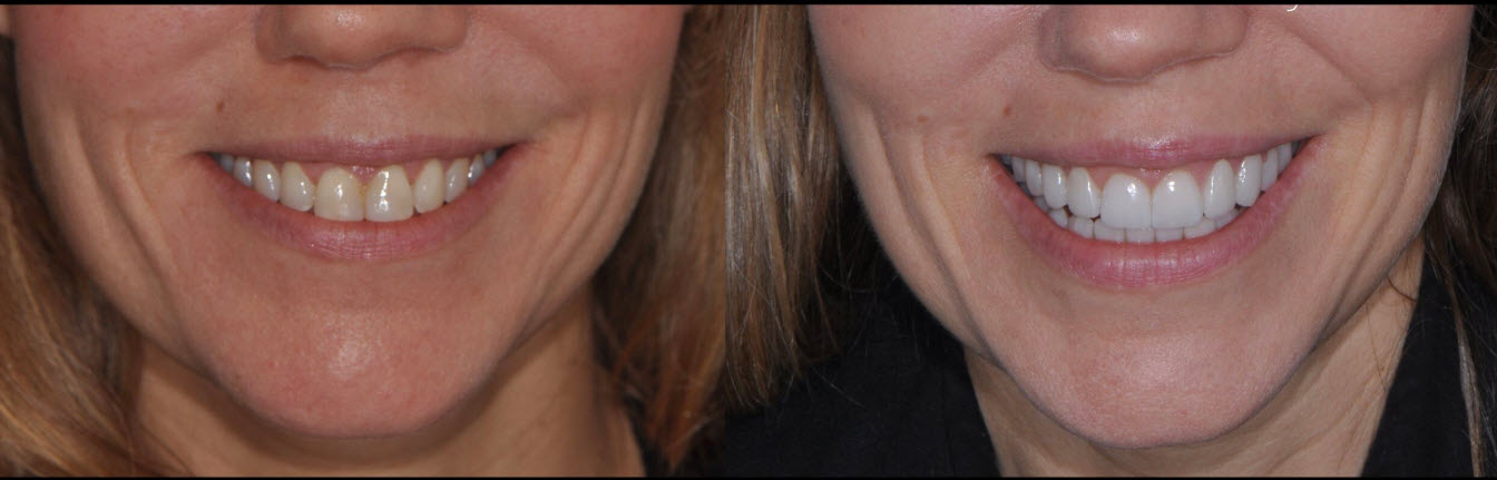 Ceramic Veneers NYC