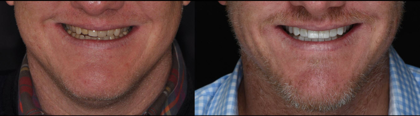 NYC Ceramic Veneers
