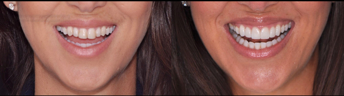 Cermaic Veneers_small4 Ceramic Veneers in New York City