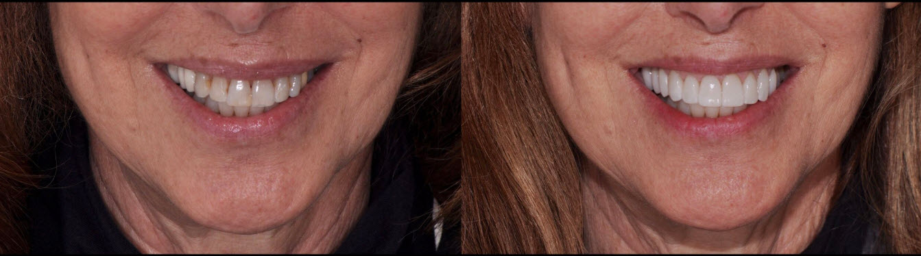 porcelain veneers before and after