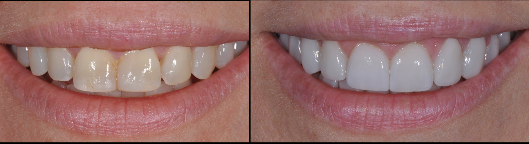 NYC Ceramic Veneers