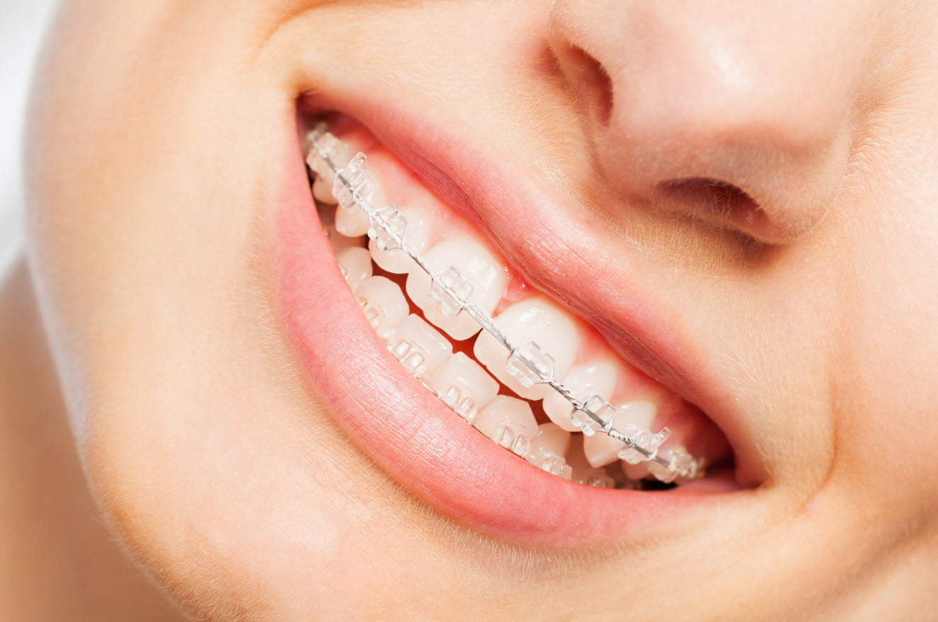 Braces for Teeth NYC