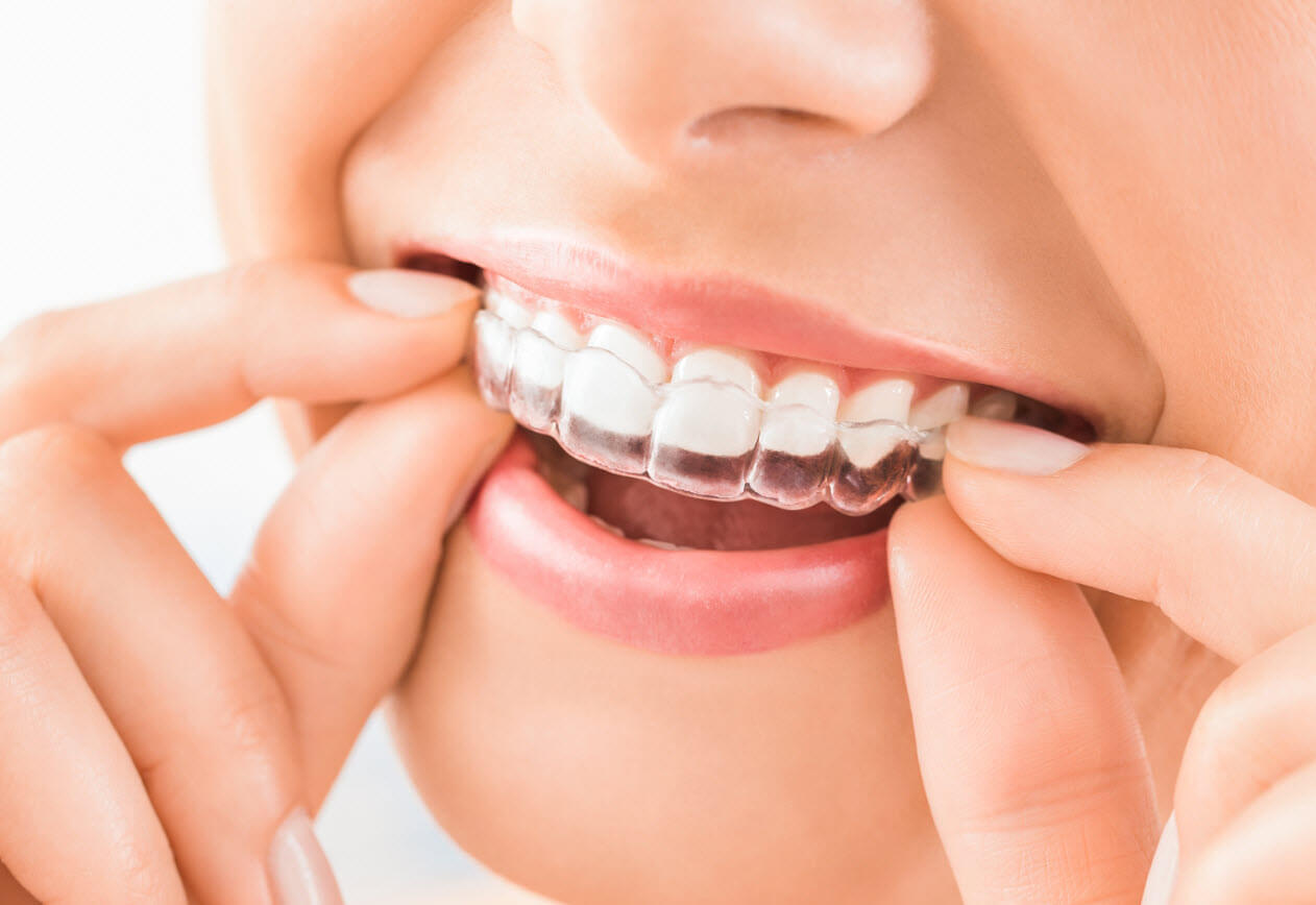 Invisalign NYC