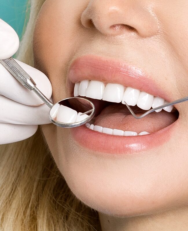 veneers